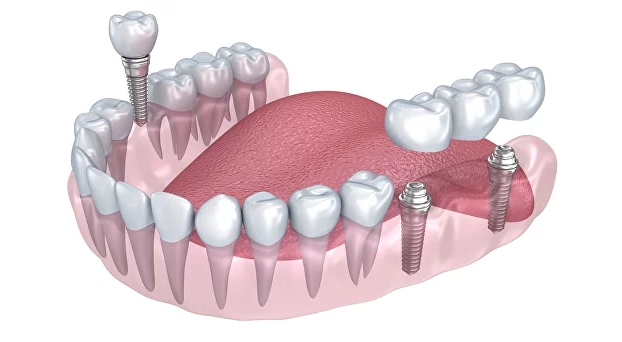 Имплантация зубов «под ключ»<br/> <small><s>22 000 руб.</s></small> 18 000 руб.